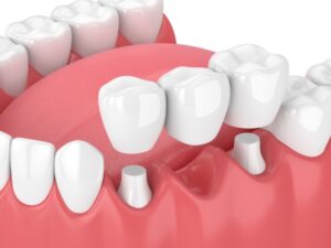 Fixed Crowns with Dental Bridges
