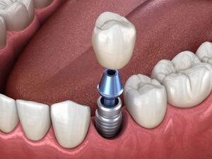 Fixed Dental Crowns with Dental Implants