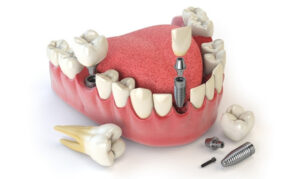 Helpful Advice Before Getting Dental Implants
