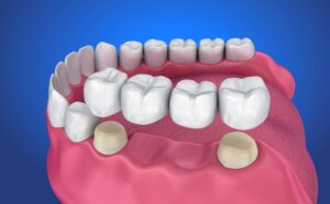 How much dental bridge treatment depends on the number of teeth that need to be restored