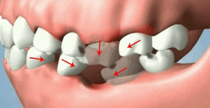 Impaired Chewing and Digestion