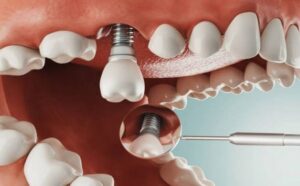 In the Case of Dental Implants