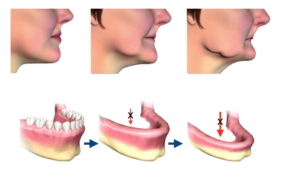 Jawbone Loss and Premature Aging