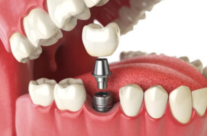 Overview of the Dental Implant Procedure