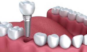 Replace Missing Teeth Dental Implants