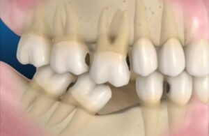 Shifting and misalignment of surrounding teeth