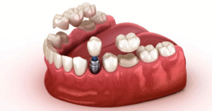 What is Dental Crown Implantation?