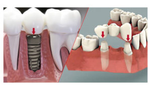Which Fixed Dental Crown Method Is the Best?